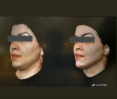 Antes e depois de tratamento de bulldog e papada — definição do contorno mandibular Antes e depois de tratamento de bulldog e papada — definição do contorno mandibular