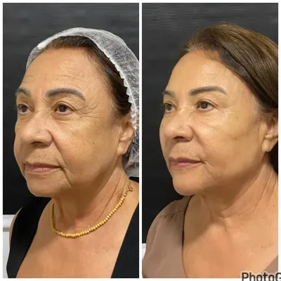 Antes e depois de contorno mandibular Antes e depois de contorno mandibular