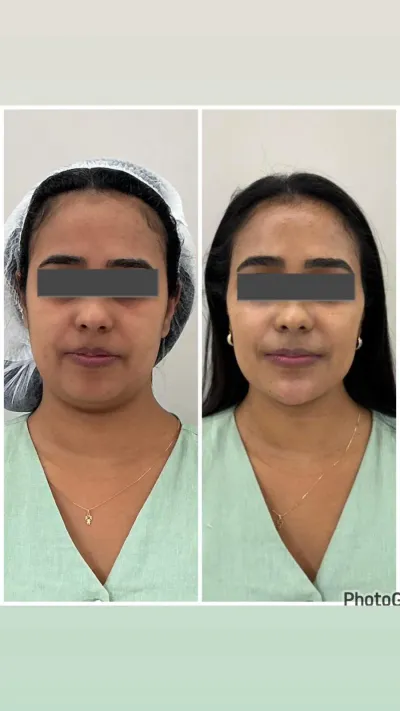 Antes e depois de harmonização facial — vista frontal Antes e depois de harmonização facial — vista frontal