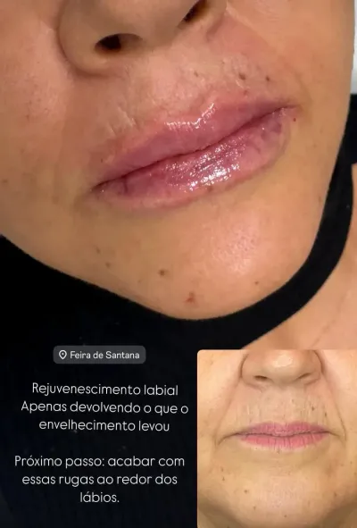 Antes e depois de preenchimento labial natural Antes e depois de preenchimento labial natural