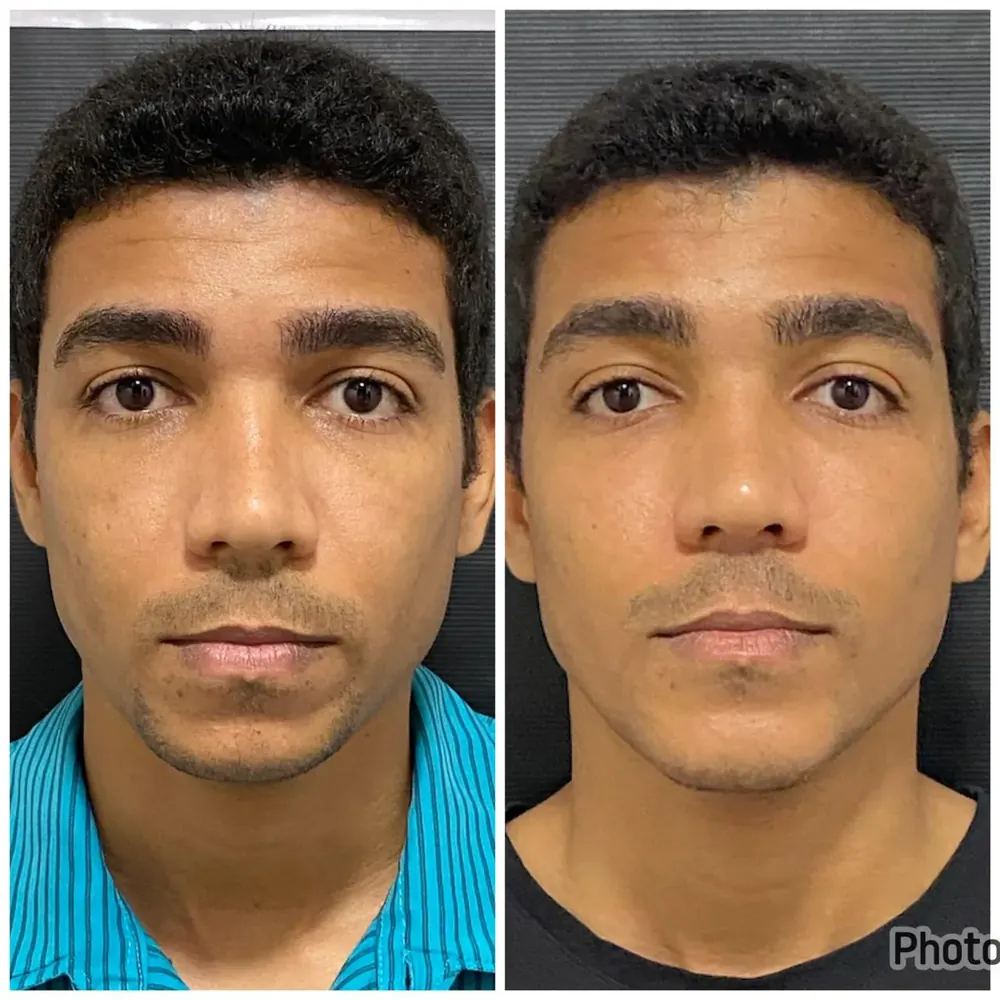 Antes e depois de harmonização facial masculina