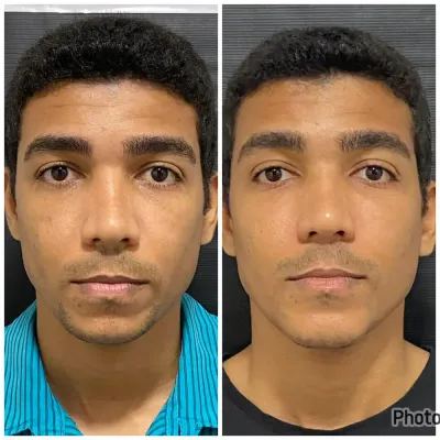 Antes e depois de harmonização facial masculina Antes e depois de harmonização facial masculina