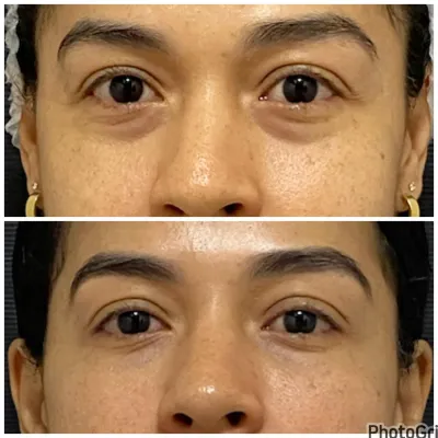 Antes e depois de tratamento de olheiras com preenchimento Antes e depois de tratamento de olheiras com preenchimento
