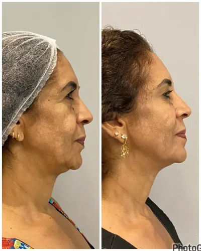 Antes e depois de tratamento de papada Antes e depois de tratamento de papada