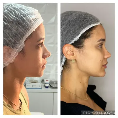 Antes e depois de harmonização do perfil Antes e depois de harmonização do perfil