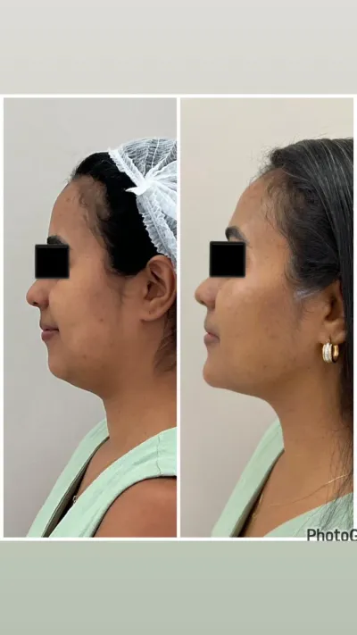 Antes e depois de harmonização facial e papada — vista de perfil Antes e depois de harmonização facial e papada — vista de perfil