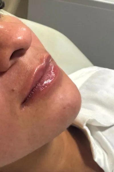 Antes e depois de preenchimento e contorno labial — resultado natural Antes e depois de preenchimento e contorno labial — resultado natural